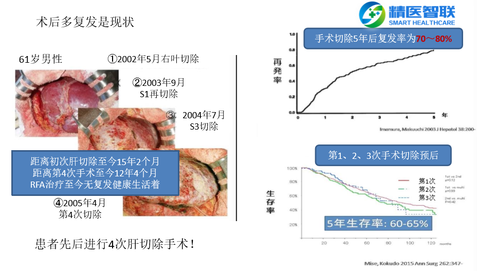 肝癌晚期最新治疗进展与希望