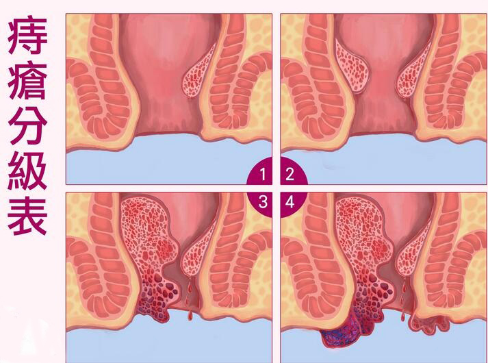 最新治疗痔疮的方法与技术